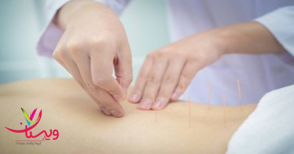 متخصص طب سوزنی در حال انجام طب سوزنی برای بیمار