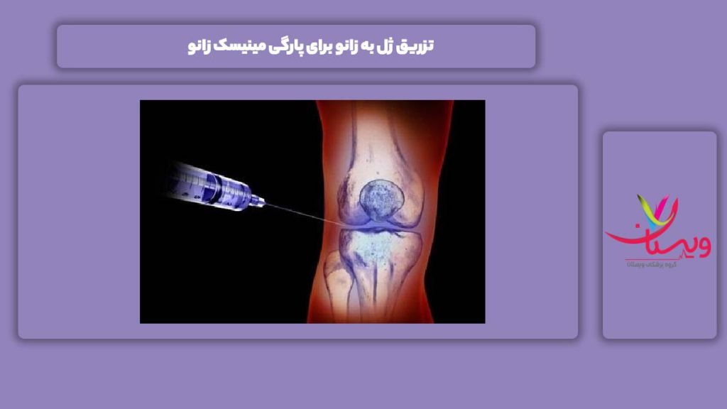 تزریق ژل به زانو برای پارگی مینیسک تزریق ژل به زانو برای پارگی مینیسک زانو