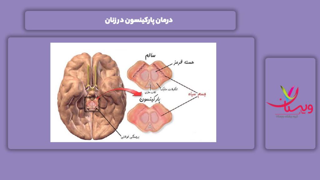 برطرف شدن این مریضی در زنها درمان پارکینسون در زنان