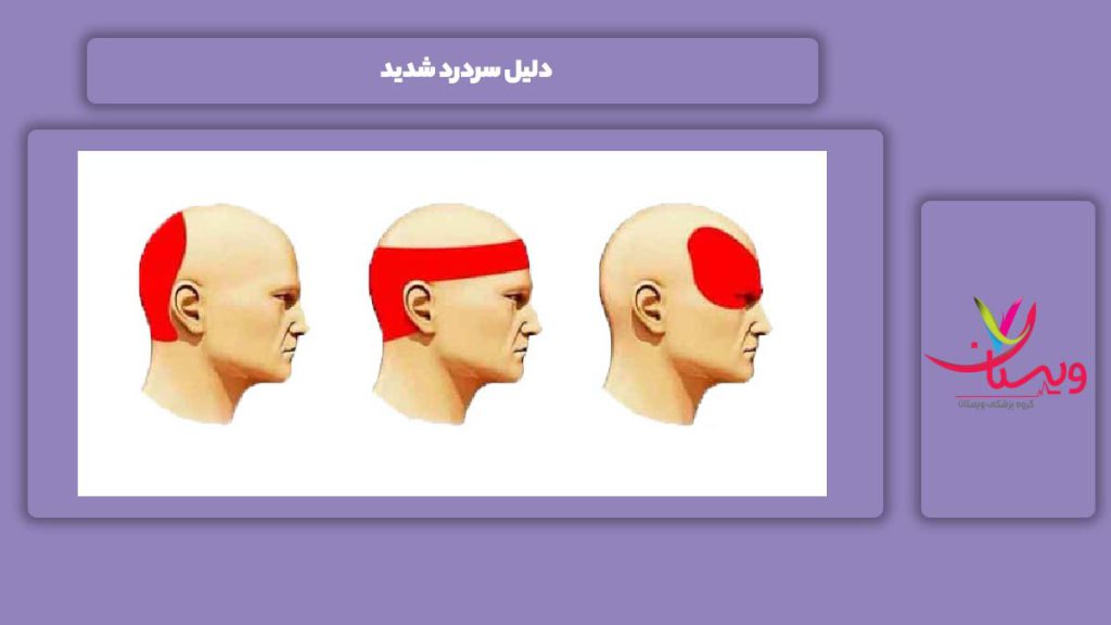 علت مبتلا شدن به این مریضی دلیل سردرد شدید