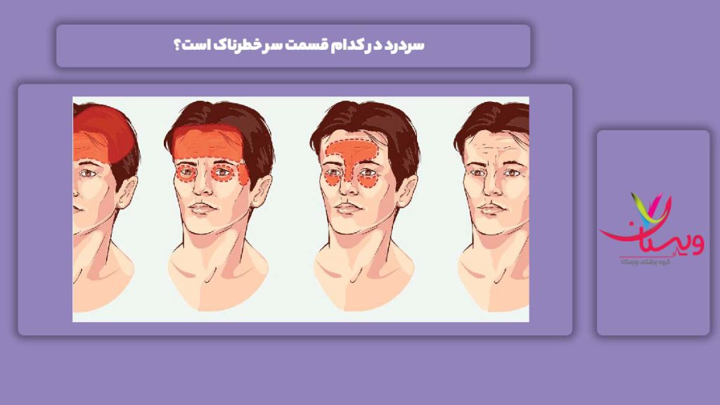 قسمتهای خطرناک سردرد در سر سردرد در کدام قسمت سر خطرناک است؟