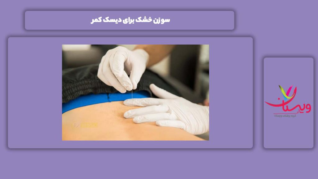 خوب بودن این تکنیک برای دیسک کمر سوزن خشک برای دیسک کمر
