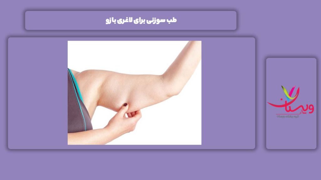 لاغری بازو توسط طب سوزنی طب سوزنی برای لاغری بازو
