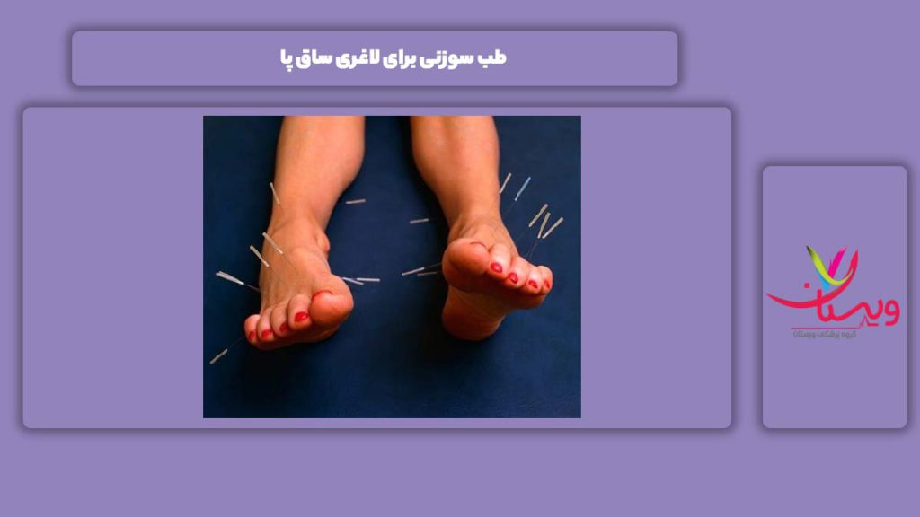 لاغری پاها با طب سوزنی طب سوزنی برای لاغری ساق پا