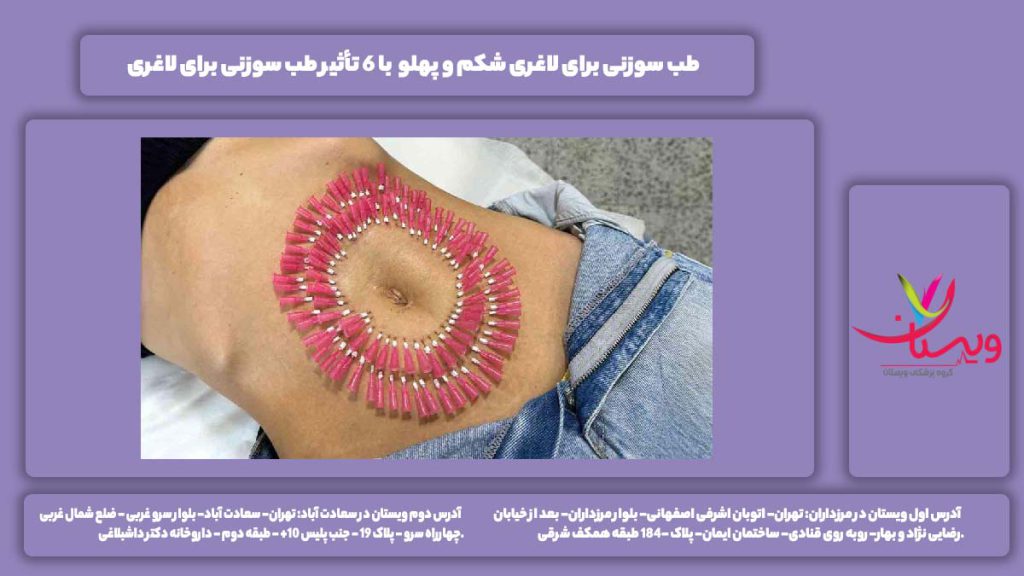 طب سوزنی برای لاغری