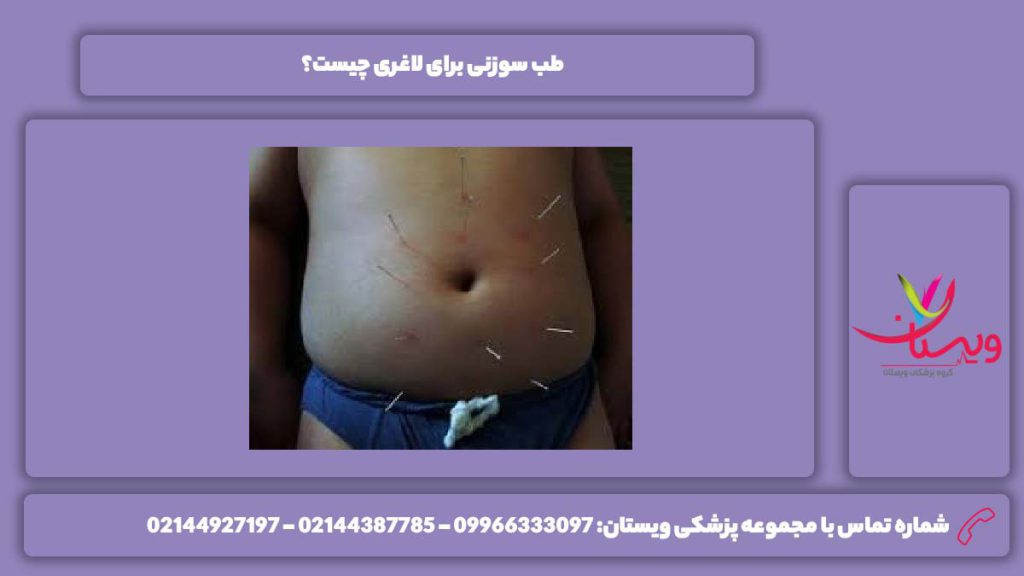 تعریف لاغر شدن با این طب طب سوزنی برای لاغری