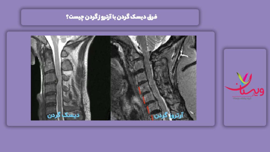 متفاوت بودن دو بیماری دیسک گردن و آرتروز گردن فرق دیسک گردن با آرتروز گردن چیست؟