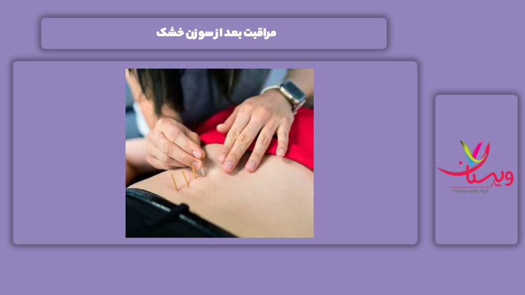 محافظت بعد از انجام این روش درمانی مراقبت بعد از سوزن خشک