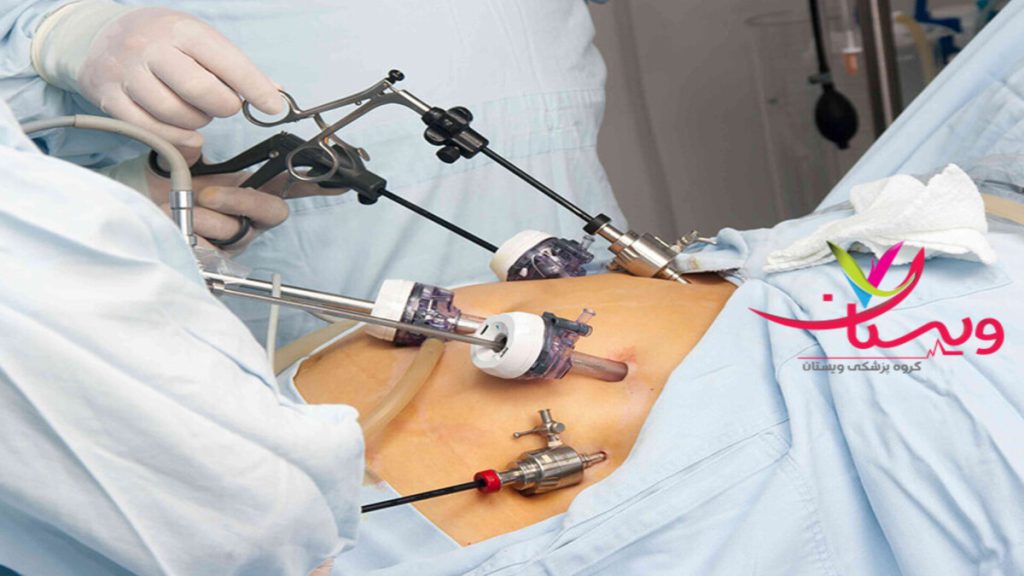 پزشک در حال انجام عمل اسلیو معده برای بیمار