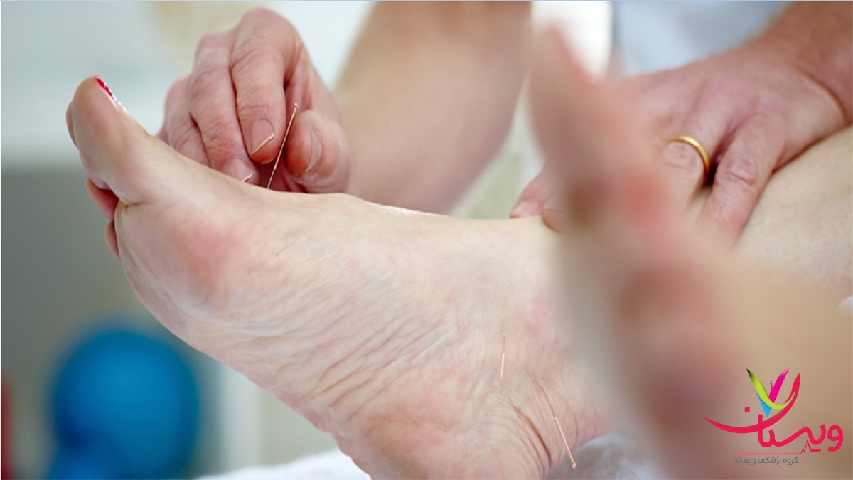 طب سوزنی برای پا طب سوزنی برای اعصاب پا
