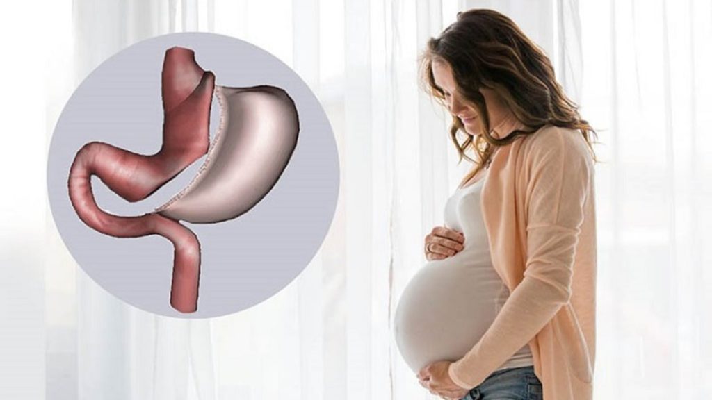 حانم باردار و عمل اسلیو معده خانم باردار که عمل اسلیو معده انجام داده است