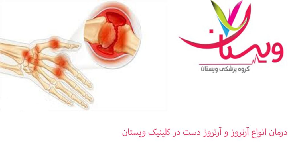 آناتومی دست بیمار آرتروزی