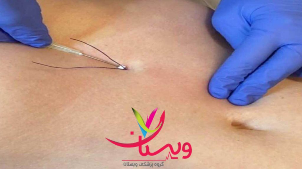 امبدینگ لاغری با سوزن توسط متخصصین ویستان انجام امبدینگ برای بیمار در کلینیک ویستان