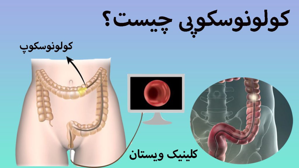 کولونوسکوپی دو تصویر دیجیتالی از کولونوسکوپی