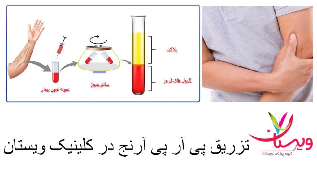 تزریق پی آرپی آرنج