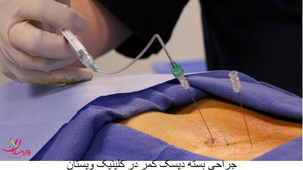عمل بسته دیسک کمر عمل بسته دیسک کمر