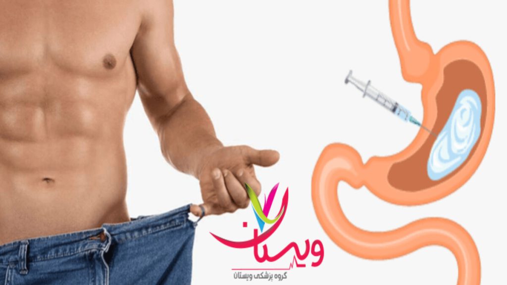 نتیجه انجام بوتاکس معده روی بیمار بیمار با انجام بوتاکس معده لاغر شده است