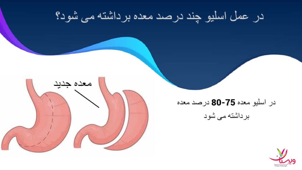 چند درصد از معده در عمل اسلیو معده جدا می شود چند درصد از معده در عمل اسلیو معده جدا می شود