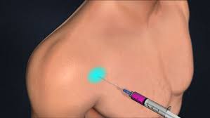 پی آر پی شانه چیست و چه کاربردهایی دارد؟ + بررسی مزایا و عوارض آن