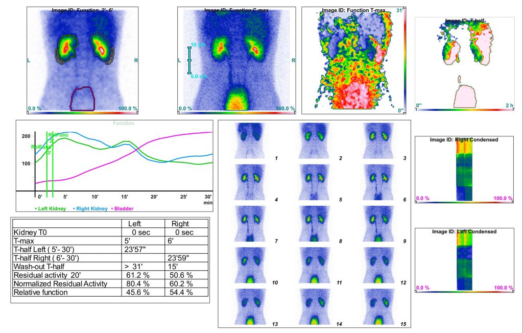 اسکن پرفیوژن