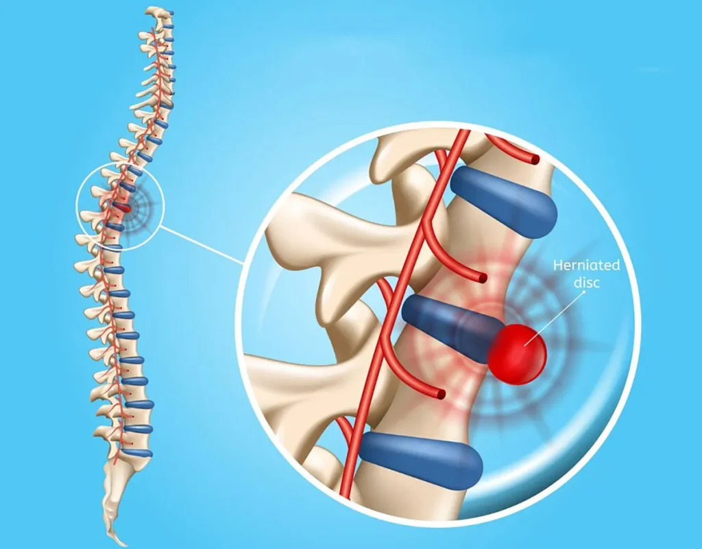 علائم دیسک کمر