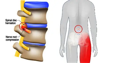 علائم دیسک کمر