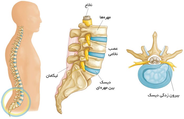 علائم دیسک کمر