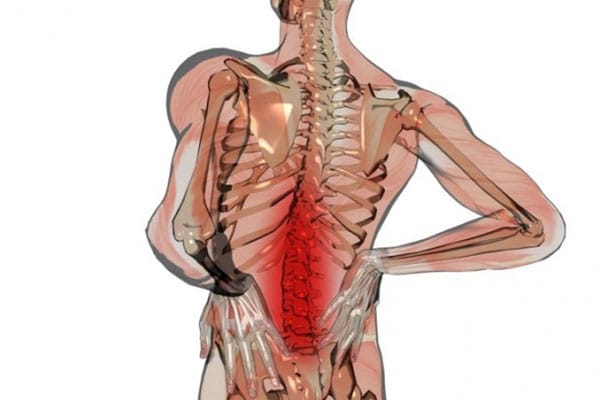 علائم دیسک کمر