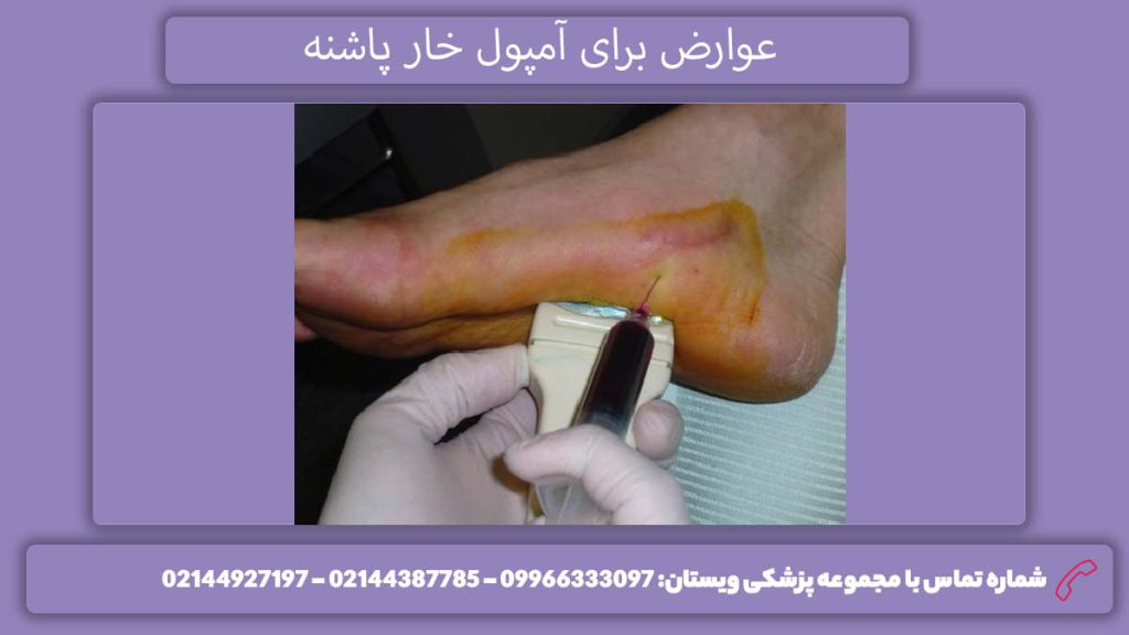 مضرات داروی تزریقی خار پاشنه عارضههای تزریق آمپول جهت درمان