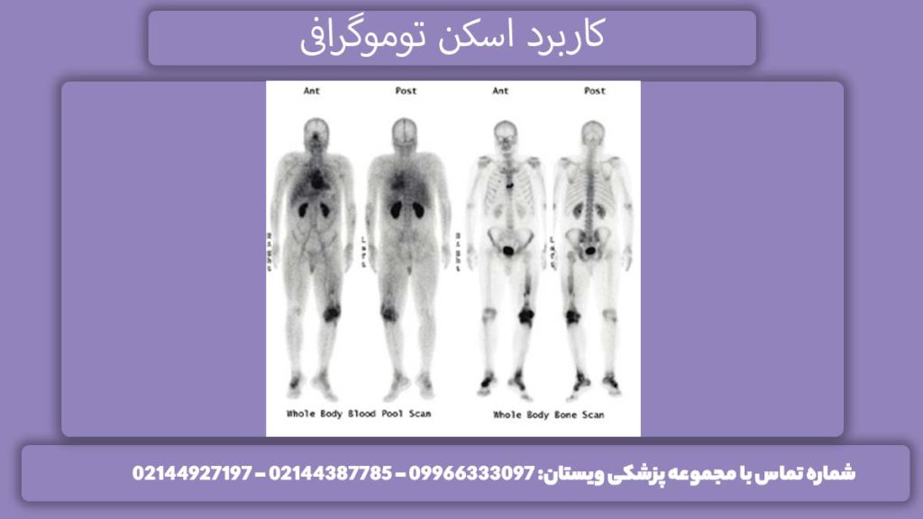حوزه به کارگیری اسکن توموگرافی زمینههای استفاده پت اسکن