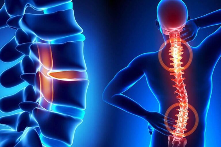 سندروم فاست لومبار