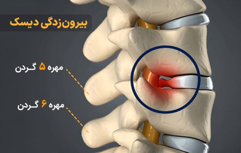 فتق دیسک با ام آر آی بهتر تشخحیص می شود. فتق دیسک گردن