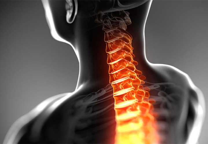 تشخیص مهره های گردن به درمان دیسک کمک بیشتری می کند. فتق دیسک گردن