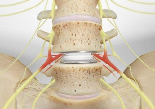 فتق دیسک گردن باعث تورم اعصاب گردن می شود. فتق دیسک گردن