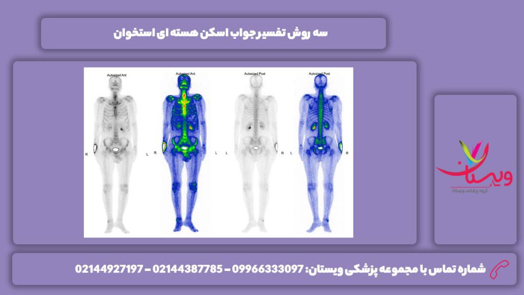 روشهای تفسیر جواب این نوع اسکن اسکن هسته ای استخوان