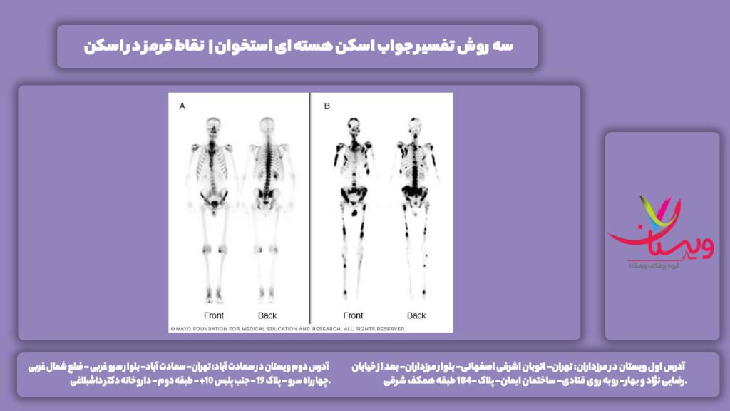 اسکن هسته ای استخوان