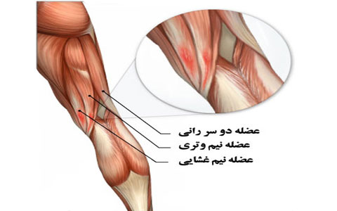 درد تانینوپاتی همسترینگ معمولا به تدریج شروع می شود. تاندینوپاتی همسترینگ یک بیماری شایع که مربوط به فعالیت های ورزشی است.
