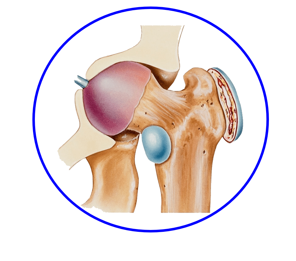 برای کاهش درد بورسیت تروکانتریک لگن از انجام فعالیت های سخت جلوگیری کنید.