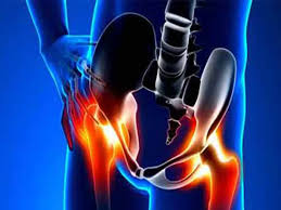 یکی از نشانه های بورسیت لگن تورم کیسه های بورسی است. بورسیت تروکانتریک لگن در اثر ورم های بورس ایجاد می شود.