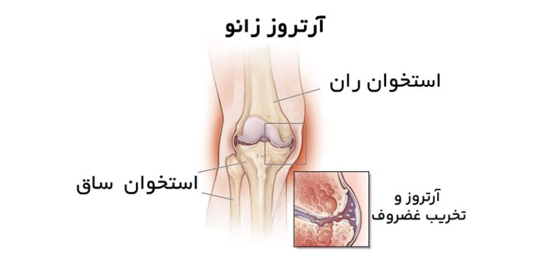 در آرتروز زانو غضروف مفصل زانو تخریب می شود. افزایش وزن یکی از عواملی است، که سبب آرتروز زانو می شود.