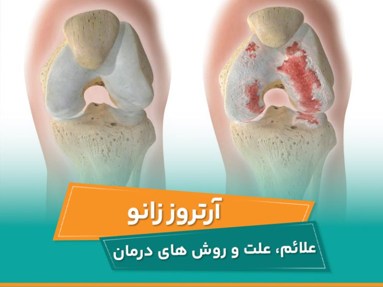 آرتروز زانو سبب تخریب و ساییدگی مفصل می شود. آرتروز زانو زمانی رخ می دهد که غضروف زانو بشکند.