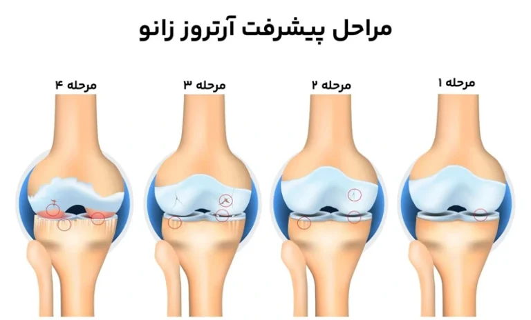 بیماری آرتروز زانو از مرحله ای به مرحله دیگر شدیدتر می شود. آرترورز زانو از مرحله ای به مرحله دیگر شدیدتر می شود.