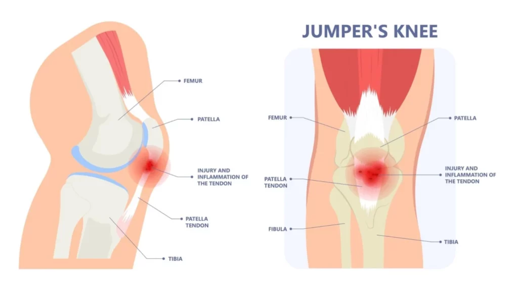 درد تاندینوپاتی همسترینگ با انجام فعالیت های مکرر مانند نشستن زیاد یا دویدن بیشتر می شود. تاندینوپاتی همسترینگ یکی از عوامل شناخته شده درد در حالت نشسته می باشد.
