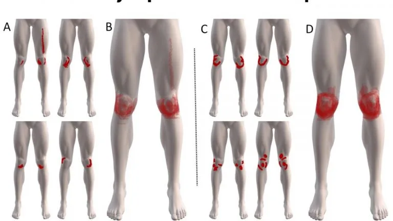 سندروم درد پاتلوفمورال دارای چهار مرحله است. دویدن یا پریدن از ارتفاع درد پاتلوفمورال را افزایش می دهد.