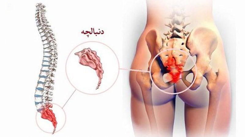 درد دنبالچه