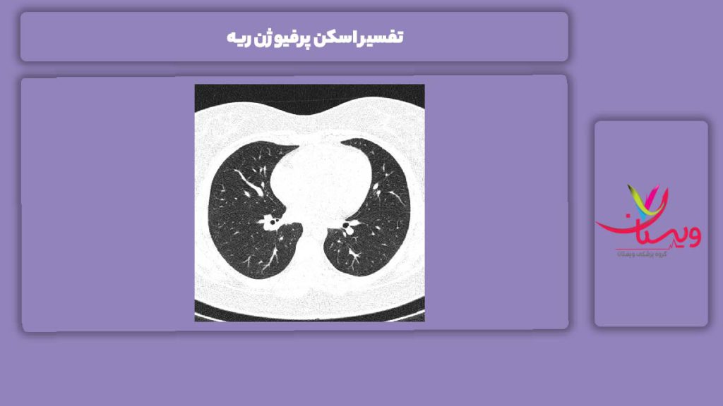 تفسیر عکس اسکن ریه تفسیر اسکن پرفیوژن ریه