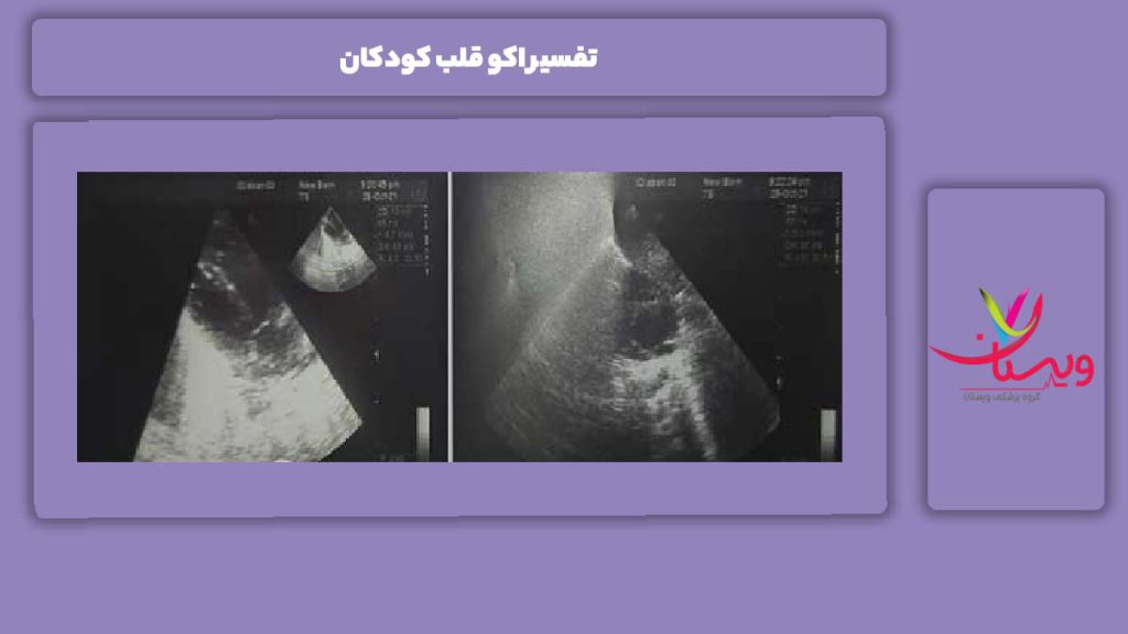 ویژگی تفسیر کردن جواب اکو قلب نوزادها تفسیر اکو قلب کودکان