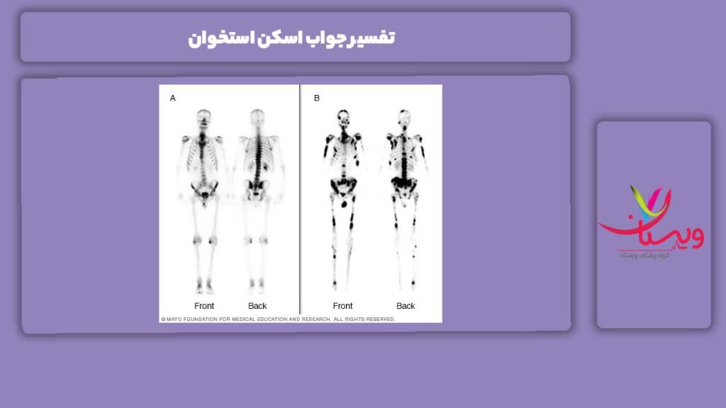 تفسیر جواب انجام اسکن استخوان تفسیر جواب اسکن استخوان