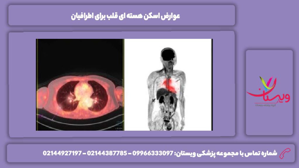 مضرات انجام این اسکن اسکن هسته ای قلب چیست