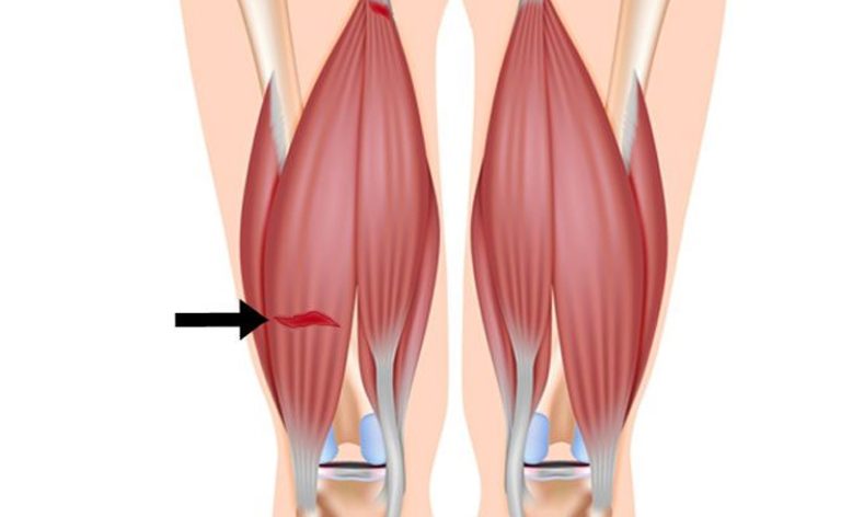 هنگام استفاده زیاده از تاندون سبب پارگی تاندون می شوند که درد زیادی دارد. تاندینوپاتی همسترینگ گروهی از عضلات قدرتمند است که از ناحیه لگن تا زانو کشیده شده است.